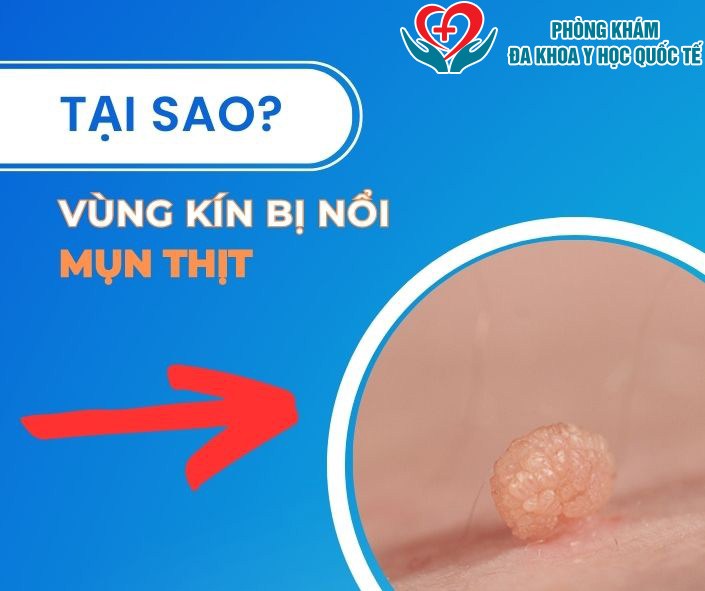 Tại sao vùng kín bị nổi mụn thịt?